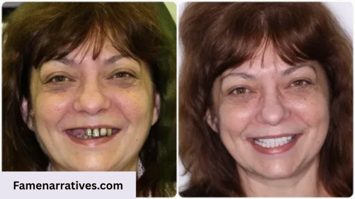 Celebrities That Have Dentures